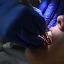 The NHS dental crisis is leading people to perform at-home dentistry, according to an orthodontist 