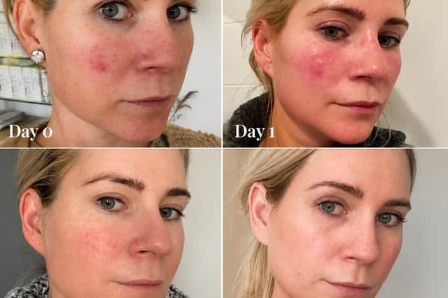 Omnilux Contour Face results imagery showing changes in the appearance of one user’s skin from Day 0 to Week 6.