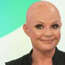 Presenter Gail Porter lost her hair due to alopecia in 2005