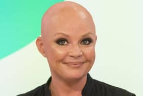 Presenter Gail Porter lost her hair due to alopecia in 2005