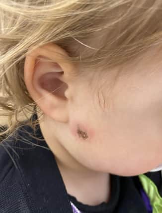 A two year old girl who was struck in the face by a firework thrown into the garden of her home in Rockfield Heights in Newry on Halloween night.