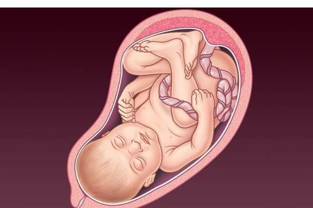 An NHS image of a foetus at a late stage of gestation; the new abortion framework brought in during spring allows for abortion up until the point of birth in Northern Ireland (though such cases may well prove relatively rare)