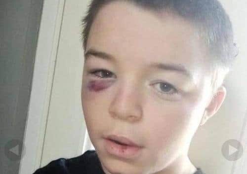 Jackson Taylor after the incident - pic from Lower Lower North Belfast Concerned Residents