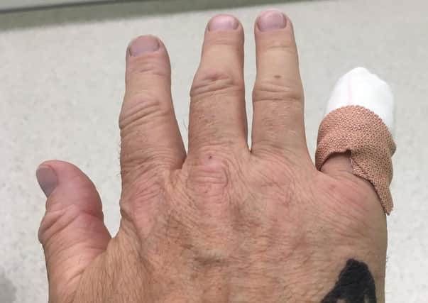 Stephen Watson's injured finger