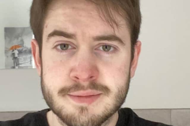 Lupus sufferer Shay Horan, 22, from Dundonald