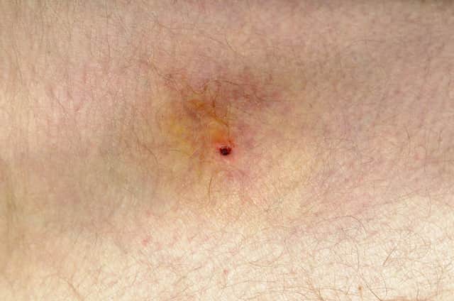 The PHA has issued a warning over tick bites