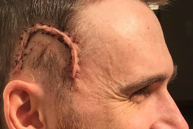 Sean Crossey with scar