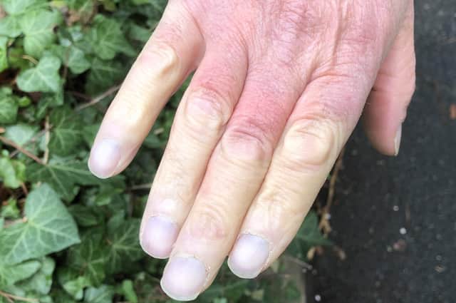 A person's hands following a Raynaud's attack
