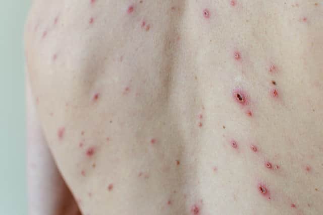 An adult's back with chickenpox