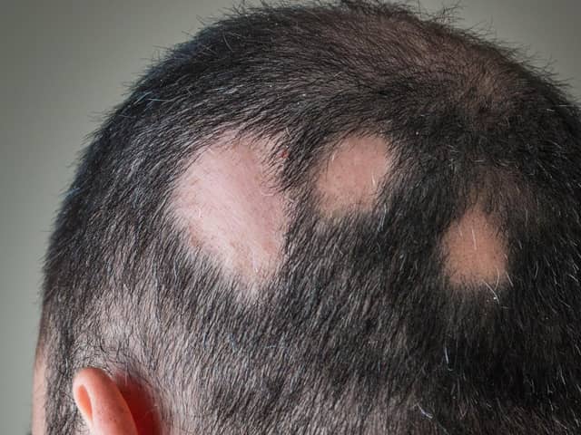 A person with alopecia areata