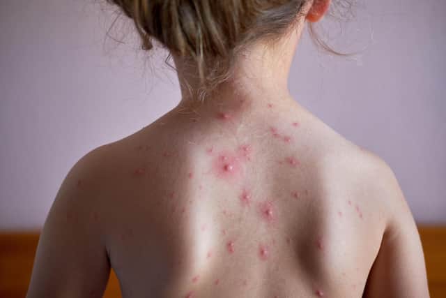 A little girl with chickenpox.