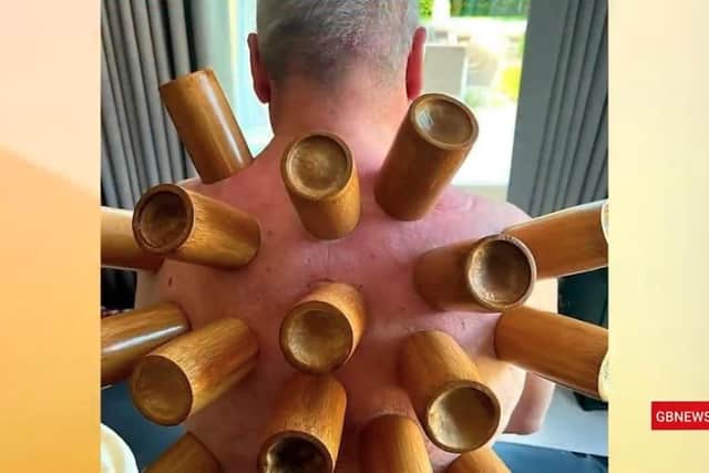 TV host showed picture of himself covered in wooden cups as part of cupping therapy