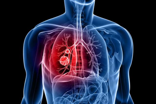 The Tagrisso treatment for learly stage ung cancer is not approved in NI - but is in GB