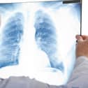 The lung cancer treatment has not been approved for Northern Ireland