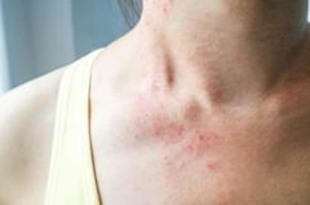 Eczema is more than just dry skin