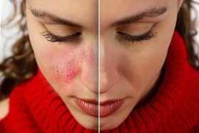 A woman with the skin condition Rosacea.