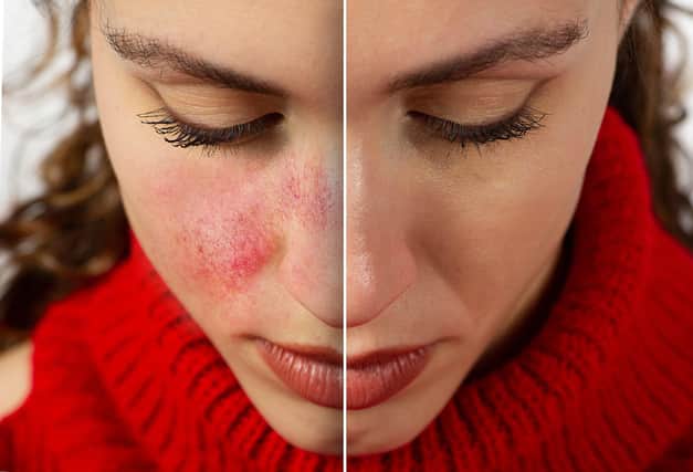 A woman with the skin condition Rosacea.