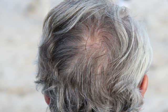 Scientists may have discovered that the process of hair turning grey is caused by certain stem cells becoming stuck in a follicle bulge