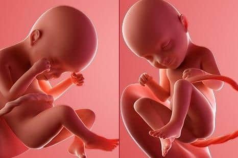 Graphics from the NHS showing babies at 24 weeks (when they are viable outside the womb) and 33 weeks (roughly when Carla Foster illegally aborted hers)