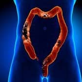 Researchers have discovered a potential treatment for bowel cancer