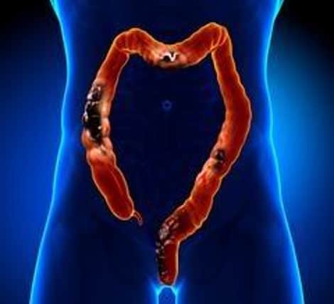Researchers have discovered a potential treatment for bowel cancer