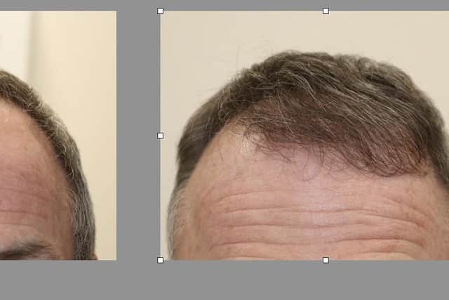 A successful hair transplant carried out by Brenda Fogarty FRCS(Plast), consultant plastic surgeon at the Paradigm Clinic in Belfast and the NHS