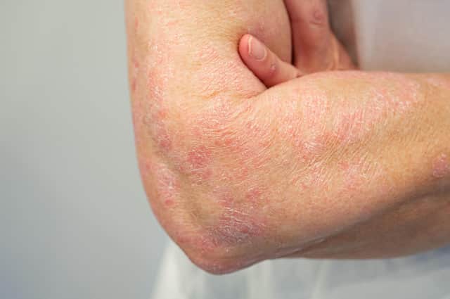 Psoriasis on arm and hand.