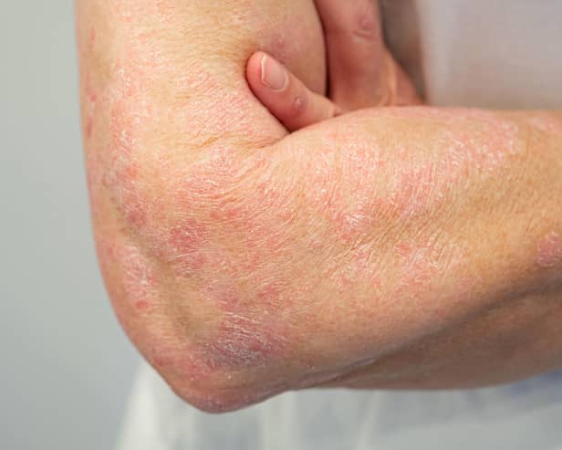 Psoriasis on arm and hand.