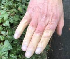 Raynaud's can cause fingers to go numb and dead-looking