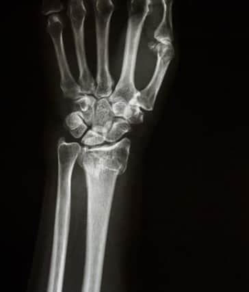 An X-Ray shows the large radius bone fractured at the hand