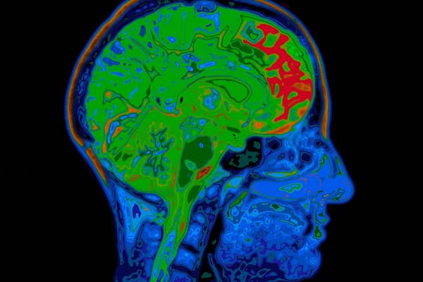 A Generic Photo of MRI scan image. See PA Feature HEALTH Dementia. Picture credit should read: Alamy/PA. WARNING: This picture must only be used to accompany PA Feature HEALTH Dementia.