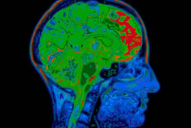 A Generic Photo of MRI scan image. See PA Feature HEALTH Dementia. Picture credit should read: Alamy/PA. WARNING: This picture must only be used to accompany PA Feature HEALTH Dementia.