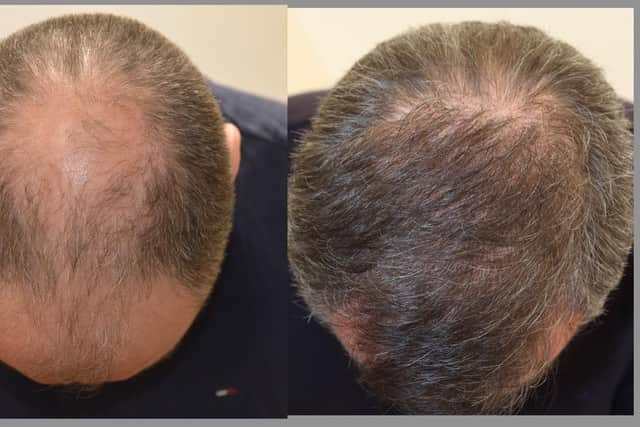 Some studies show those with hair loss have a higher risk of developing squamous cell carcinomas and basal cell carcinomas than those with a full head of hair