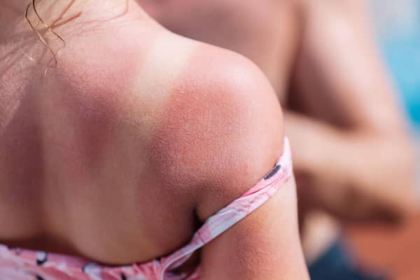 Red back of a girl with a sunburn and white lines from a swimsuit.