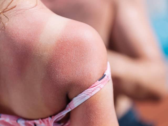 Red back of a girl with a sunburn and white lines from a swimsuit.
