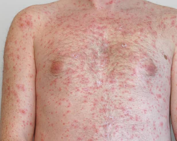 The skin rash caused by measles.