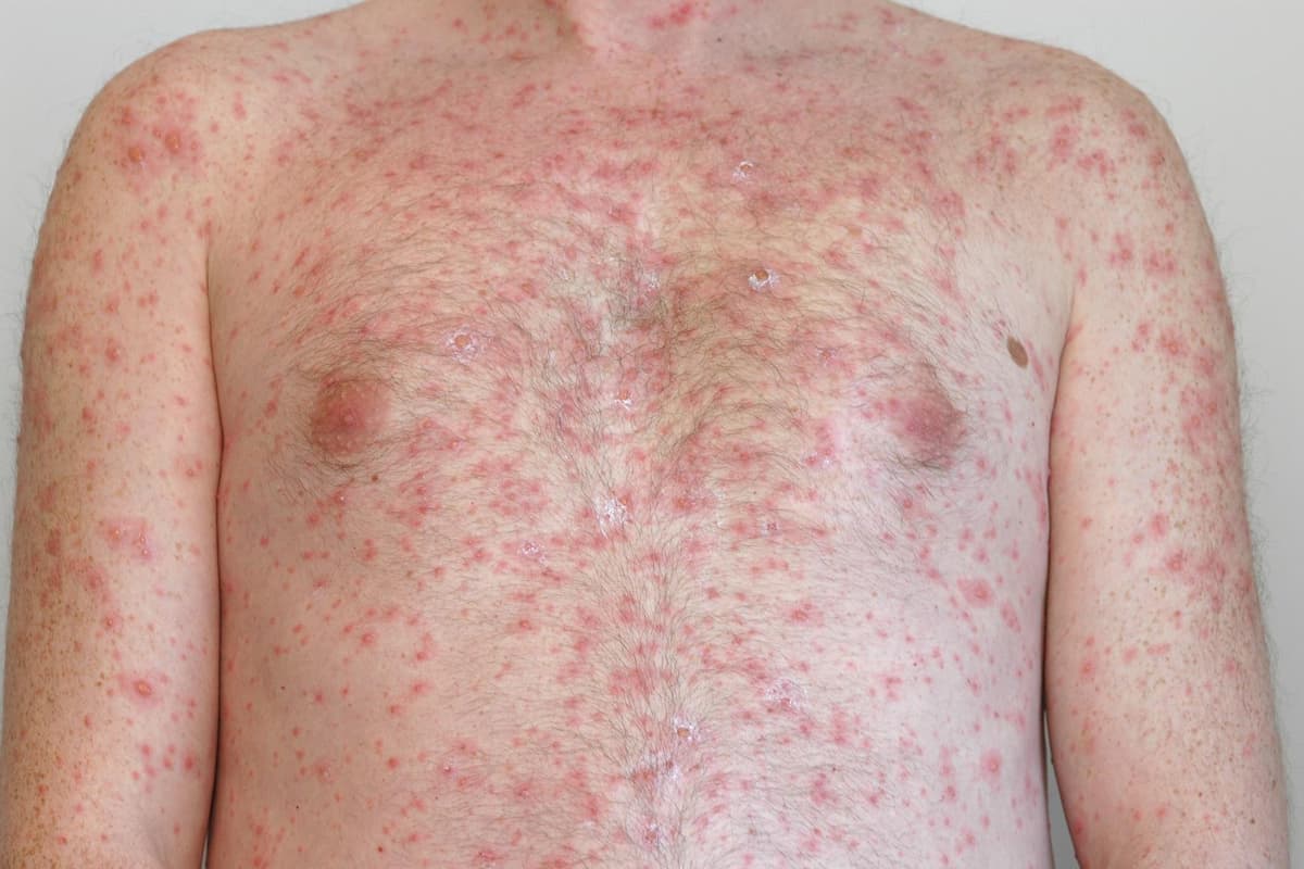 Measles: First case of illness in Northern Ireland for seven years is confirmed