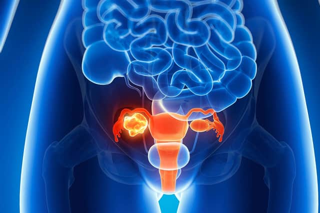 Bloating, feeling full quickly, abdominal pain, and needing to wee more frequently can all be symptoms of ovarian cancer