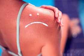 Woman with sun protection cream on her shoulder in the shape of sad smile.