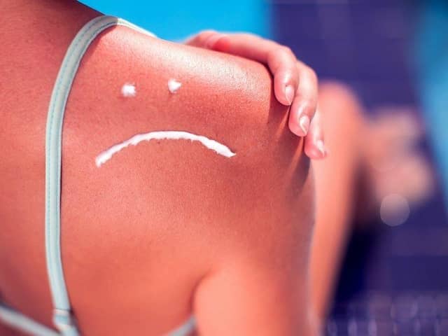 Woman with sun protection cream on her shoulder in the shape of sad smile.