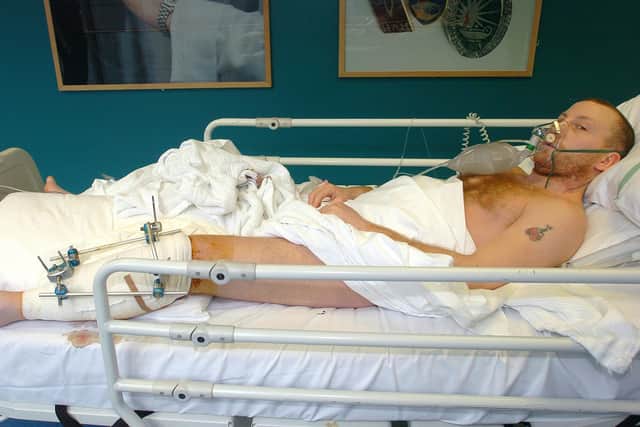 02-03-04: Then-WBU welterweight champion Eamonn Magee in his hospital bed at the Royal Victoria Hospital in Belfast after he had his leg broken in the beating