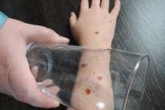 A very important sign of meningitis is  a rash that does not disappear if a glass is pressed against it.