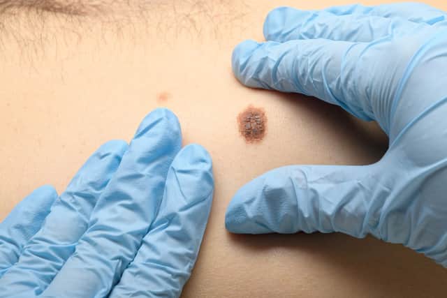 A doctor examines a mole for the presence of skin cancer