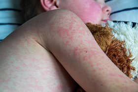 There have been 10 confirmed cases of measles in Northern Ireland