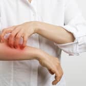 Scabies is an itchy rash caused by mites