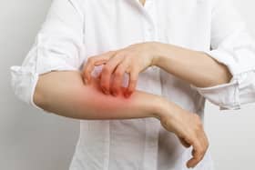 Scabies is an itchy rash caused by mites
