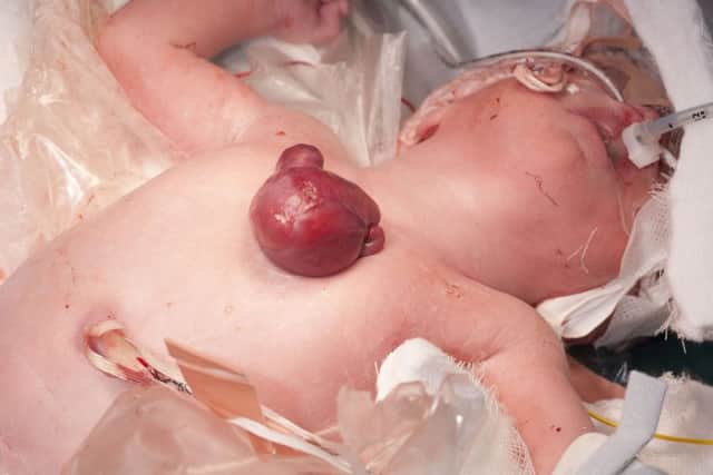 Miracle baby Vanellope shortly after her caesarean delivery