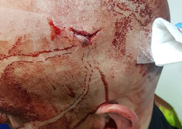 Picture taken from the twitter feed of @wyp_AlexArtis of an injured West Yorkshire Police officer (name not given) who was injured when he was assaulted while policing 'Mad Friday' in Bradford.