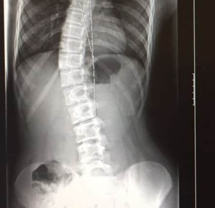 An x-ray showing the extent of the curve in Mia's spine.