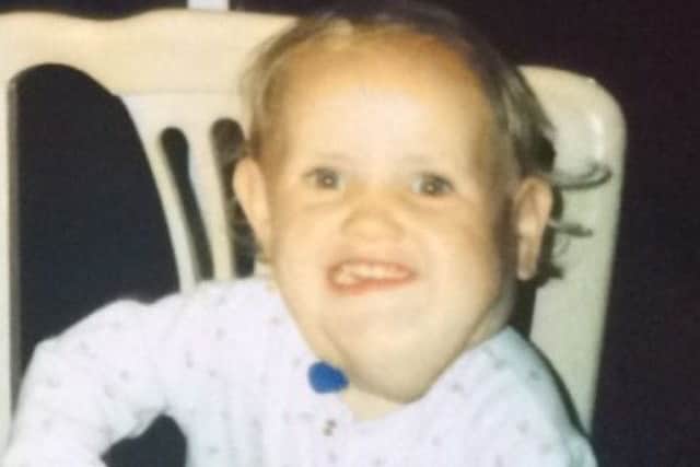 Amy Mullan who was born with the rare condition Cystic Hygroma pictured as a child.